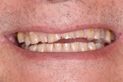 Facetas Dentárias - Caso Clinico - Antes e Depois