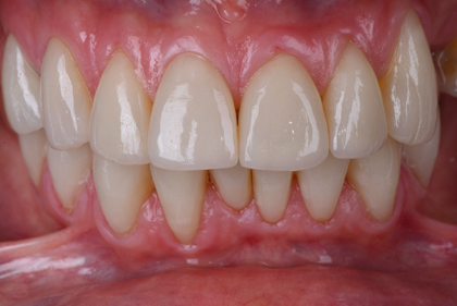 Facetas Dentárias - Caso Clinico - Antes e Depois